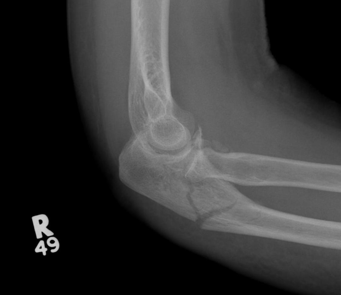 Elbow Dislocation Posterior Monteggia
